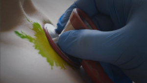 a photo representing the infection risk of a contaminated stethoscope not protected by an aseptic disk cover stethoscope barriers